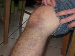 Lesión del ligamento cruzado anterior