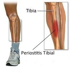 Periostitis tibial