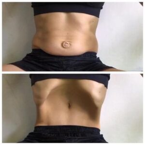 Síntomas de la diástasis abdominal