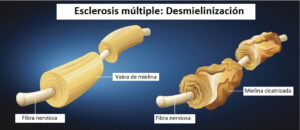 ¿Cómo se diagnostica la Esclerosis Múltiple?