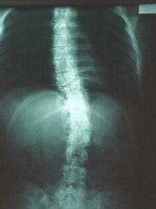 Síntomas de la Esclerosis Lateral Amiotrófica